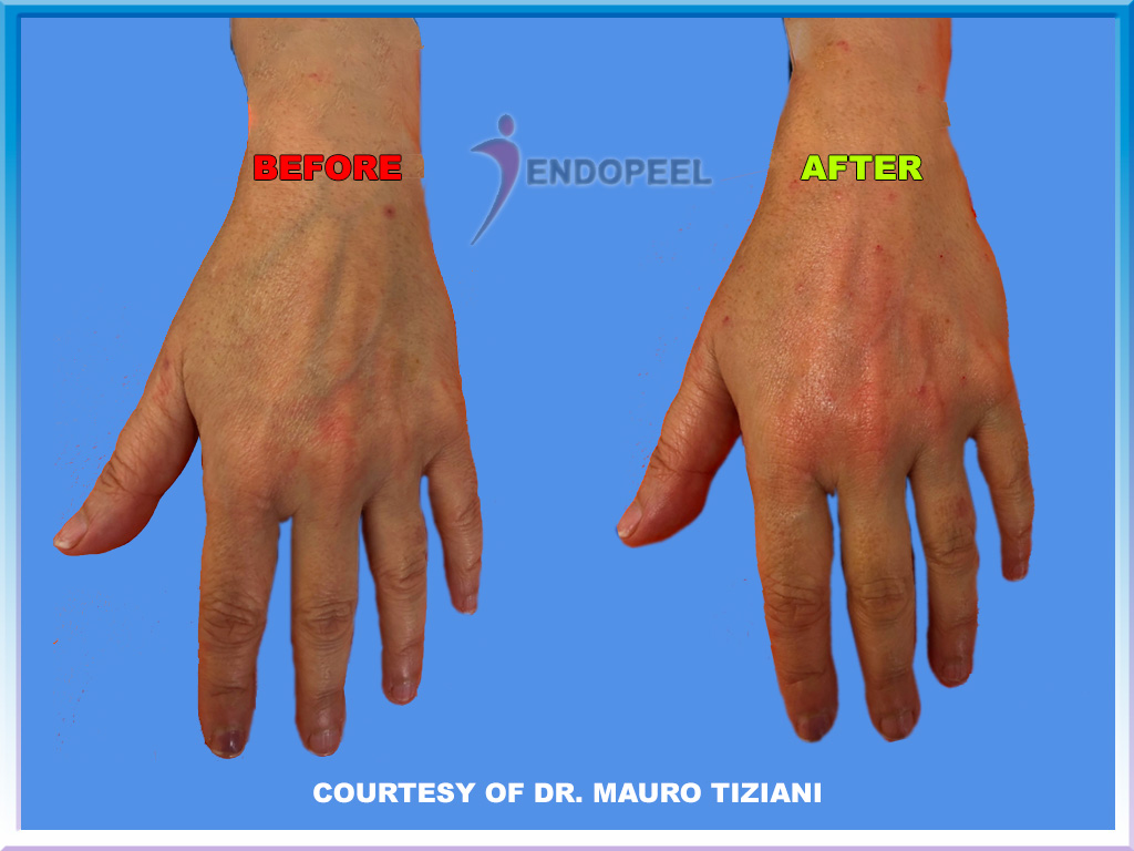 hands-endopeel